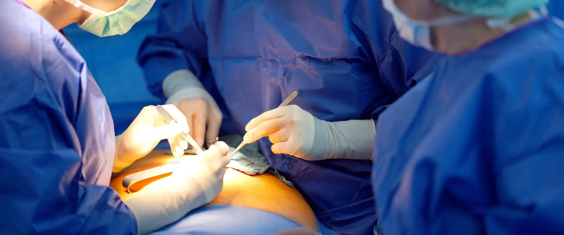 OP-Ärzte blicken in Bauchöffnung